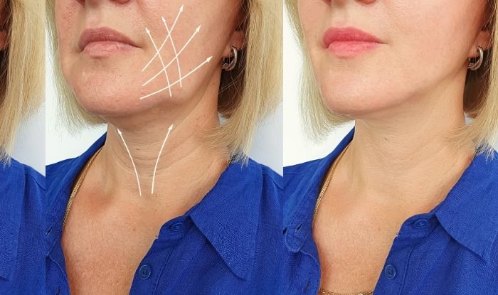 Mentón retraído (Retrognatia): Solución estética sin cirugía