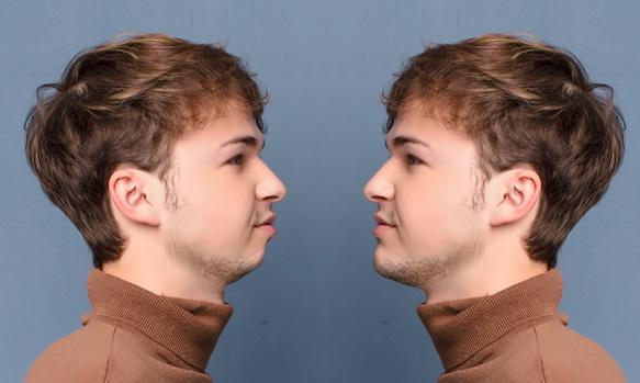 Mentón retraído (Retrognatia): Solución estética sin cirugía