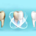 Blanqueamiento en dientes sensibles: ¿Cuál es el más seguro?