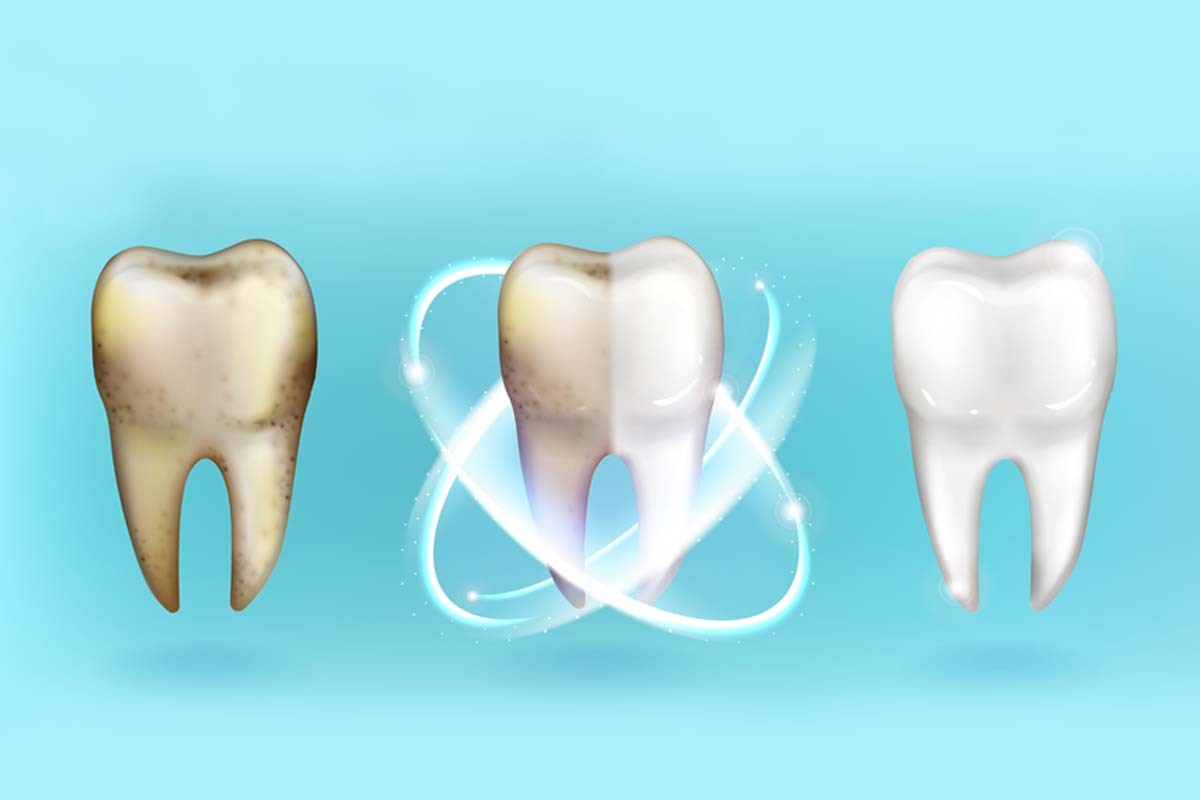 Blanqueamiento en dientes sensibles: ¿Cuál es el más seguro?
