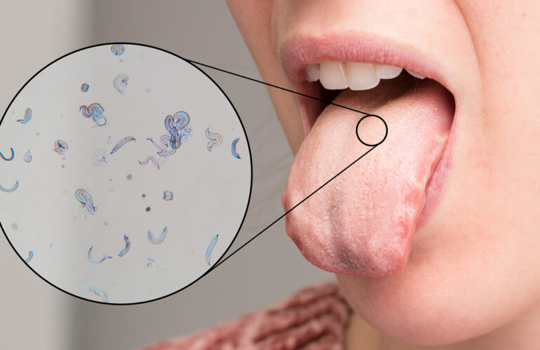 Candidiasis oral: Síntomas de hongos en la boca y tratamiento