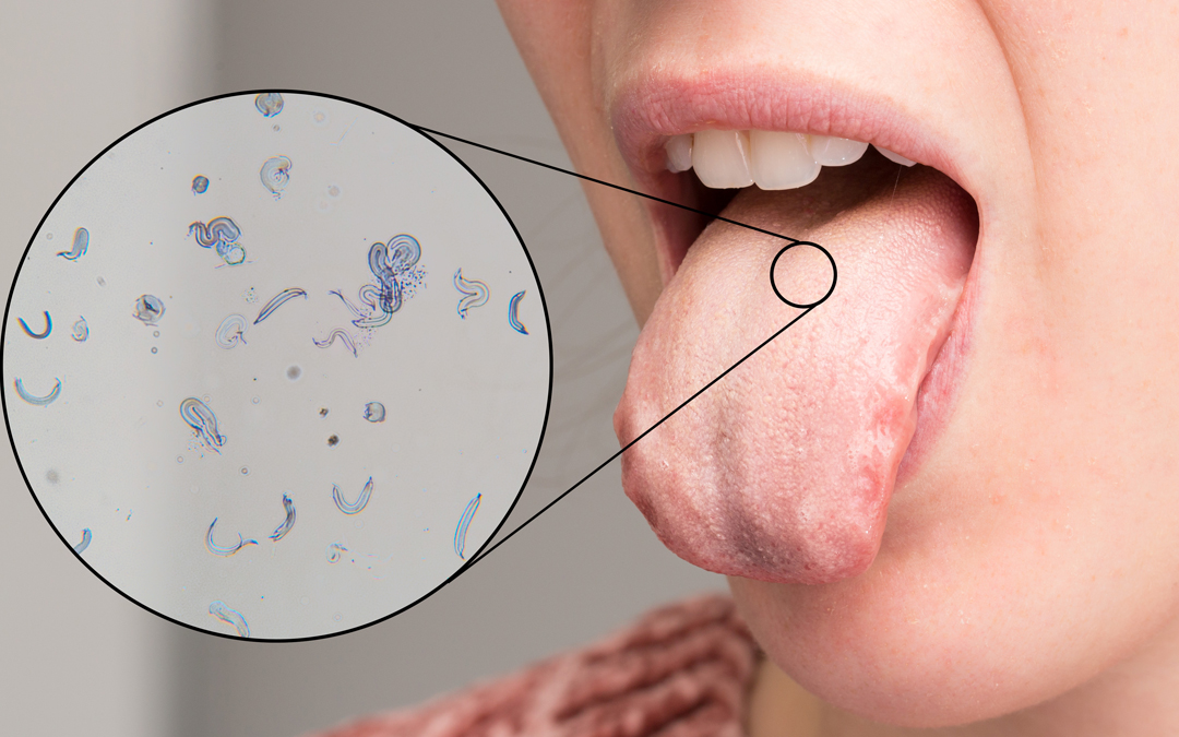 Candidiasis oral: Síntomas de hongos en la boca y tratamiento