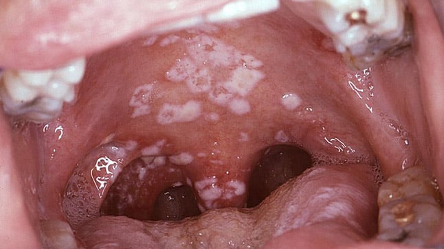 Candidiasis oral: Síntomas de hongos en la boca y tratamiento