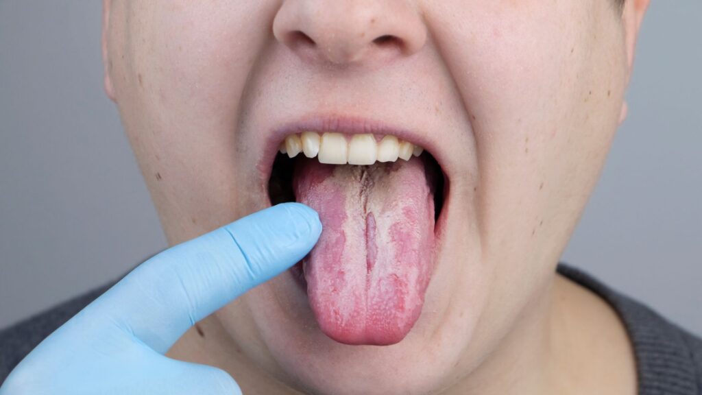 Candidiasis oral: Síntomas de hongos en la boca y tratamiento