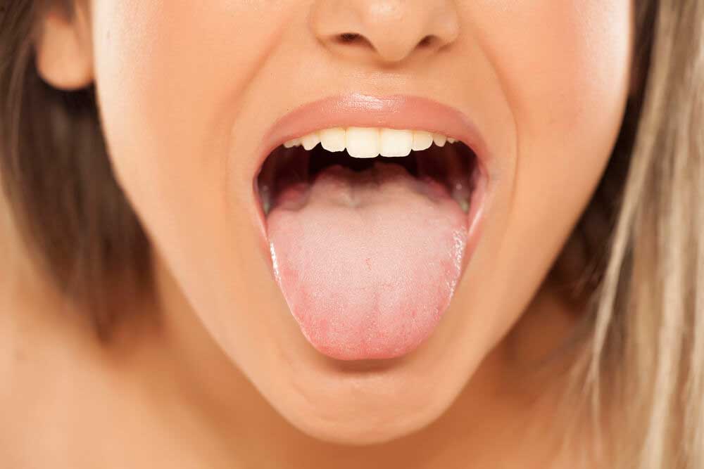 Candidiasis oral: Síntomas de hongos en la boca y tratamiento