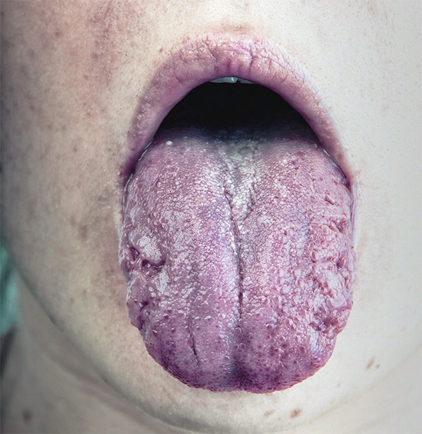 Candidiasis oral: Síntomas de hongos en la boca y tratamiento