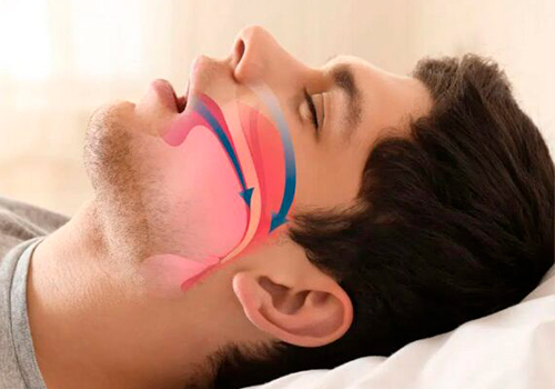 Respirador bucal: Cómo afecta a la cara y los dientes