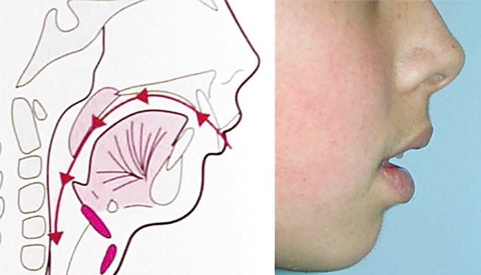 Respirador bucal: Cómo afecta a la cara y los dientes
