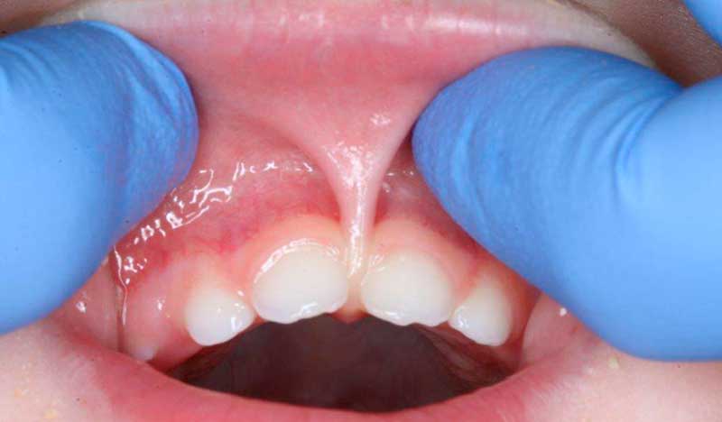 frenillo labial superior