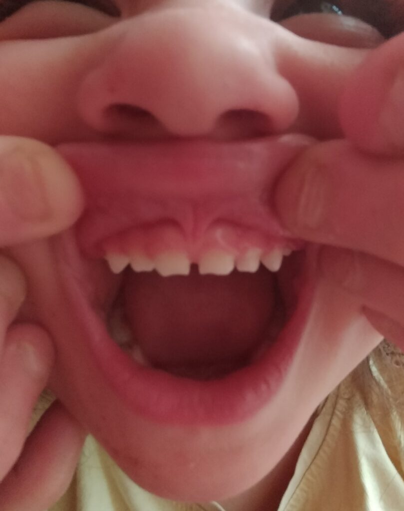 frenillo labial superior