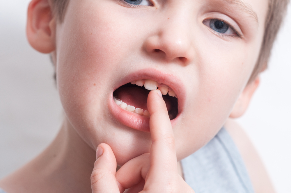 frenillo labial superior