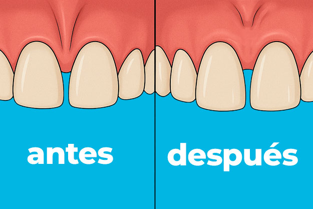 frenillo labial superior