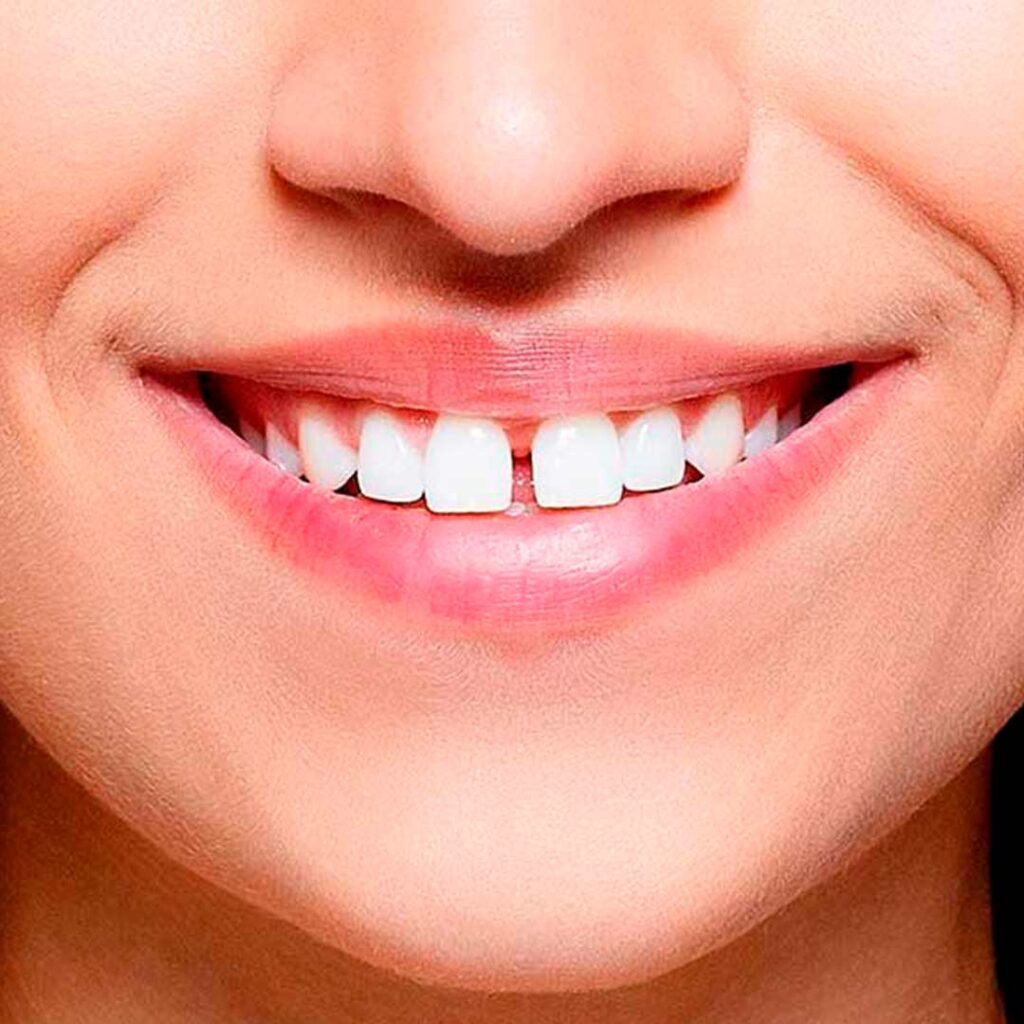 frenillo labial superior